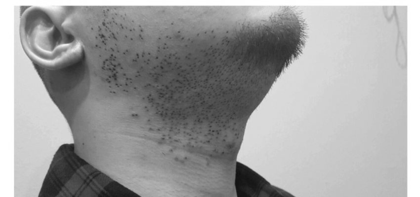 Hate hair loss, chin, leg, chest hair transplant