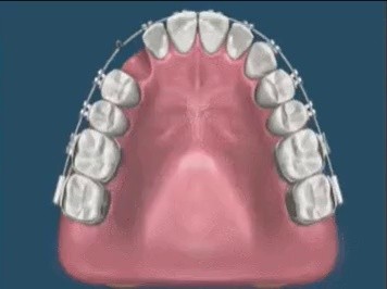 Teeth movement simulation